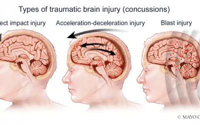 Different Types of a TBI