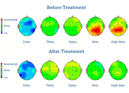 Before and after results of neurofeedback treatment at Horizon TBI and brain Center